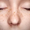 Freckles